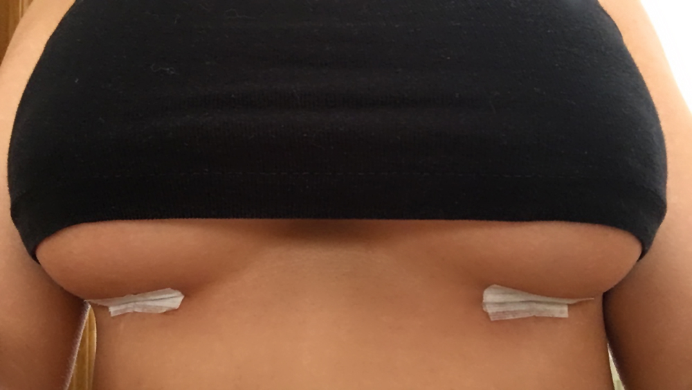 My Real/Raw Breast Augmentation Experience : What to Expect, Surgery Day,  Consultation. 